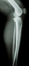 Normal human's knee&leg