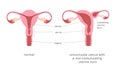 Normal human uterus and unicornuate uterus with non-comunicating uterine horn. Congenital uterine malformation anatomy