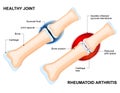 Normal Joint and Rheumatoid Arthritis Royalty Free Stock Photo