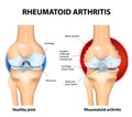 Normal Joint and Rheumatoid Arthritis Royalty Free Stock Photo
