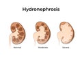 Normal kidney with hydronephrosis. Vector illustration of the of the kidney anatomy with dilated kidneys