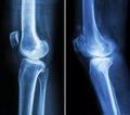 Normal knee left image and osteoarthritis knee right image lateral view Royalty Free Stock Photo