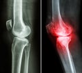 Normal knee and osteoarthritis knee