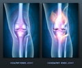 Normal knee and unhealthy knee joint Royalty Free Stock Photo