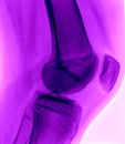 Normal Knee xray - purple