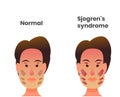 Normal lacrimal and salivary gland versus sjogren`s syndrome