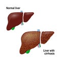 Normal liver and liver with Cirrhosis