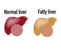 Normal liver and fatty liver, educational sheet