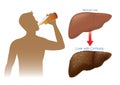 Normal liver of human change to the cirrhosis because drinking alcohol. Royalty Free Stock Photo