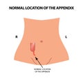 The normal location of the appendix. Vector illustration on isolated background.