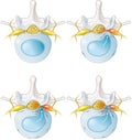 Normal lumbar disc. Disc protrusion. Disc extrusion. Disc sequestion. Labeled illustration Royalty Free Stock Photo