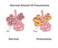 Normal lung alveoli versus pneumonia