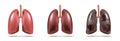 Normal lung and lung cancer illustration