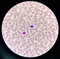 Normal lyphocyte and atypical lymphocyte