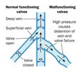 Normal and malfunctioning vein valves