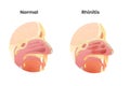 Normal nasal cavity versus rhinitis anatomy illustration