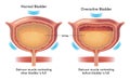 Normal and overactive bladder