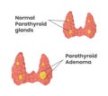 Normal parathyroid glands with parathyroid adenoma Royalty Free Stock Photo