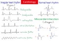 Normal and pathological ecg collection. Royalty Free Stock Photo