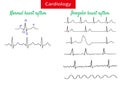 Normal and pathological ecg collection. Royalty Free Stock Photo