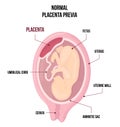 Normal Placental previa. Usual anatomical Placenta Location During Pregnancy.