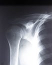 Radiography of the shoulder joint and ribs in direct projection with a fracture of the collarbone