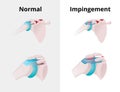 Normal shoulder and impingement. Illustration of the normal shoulder anatomy and impingement disorder