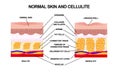 Normal skin and cellulite. illustration with symbols