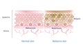 Normal skin layer and melasma skin layer vector. Royalty Free Stock Photo