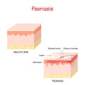 Normal skin and psoriasis