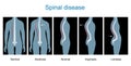 Normal spine and Spinal deformity from Scoliosis to Lordosis and Kyphosis Royalty Free Stock Photo