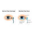 Normal Tear Drainage vs Blocked Tear Duct Design Vector Illustration Royalty Free Stock Photo