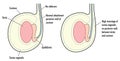 Normal testicle and testicle with high tunica vaginalis