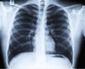 Normal thoracic x-ray image without any findings