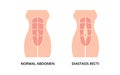 Normal toned abdomen muscles and diastasis recti Royalty Free Stock Photo