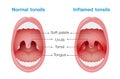 Normal tonsils and inflamed tonsils