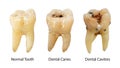 Normal tooth , Dental caries and Dental cavity with calculus . Comparison between difference of teeth decay stages . White Royalty Free Stock Photo