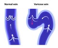 Normal vein and Varicose vein