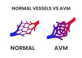 Normal vessels and arteriovenous malformation avm