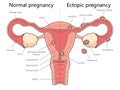 Normal vs Ectopic Pregnancy Medical science