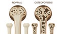 Normal vs. Osteoporosis Bone Structure Comparison Royalty Free Stock Photo