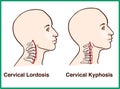 Normal vs. Reversal of Cervical Lordosis Royalty Free Stock Photo