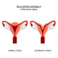 Normal womb and Bicornuate uterus Royalty Free Stock Photo