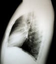 Normal x-ray of the chest, lateral