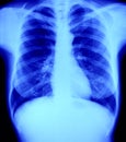 Normal X - ray radiography of chest, lung and hear Royalty Free Stock Photo