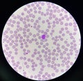 Normochromic and normocytic rbc blood smear Royalty Free Stock Photo