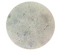 Normozoospermia analyzed by microscope