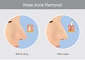 Nose Acne Removal. Illustration show human skin in case before using and after usage a products for the nose acne