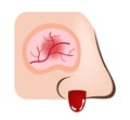 Nose bleeding / inflamed nasal and sinus