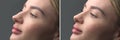 Nose Before and after plastic surgery. Rhinoplasty. Crooked nose correcting. Young woman profile portrait, over grey background